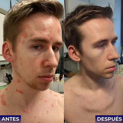 Veltrix™ Crema Intensiva Para Psoriasis